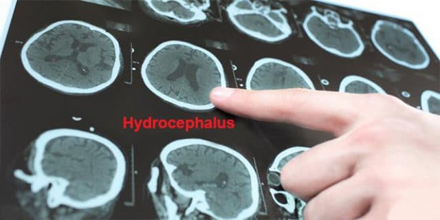 Hydrocephalus Ursachen Symptome Und Behandlung 6137