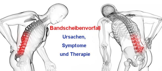 Was Ist Ein Bandscheibenvorfall? Ursachen, Symptome Und Therapie