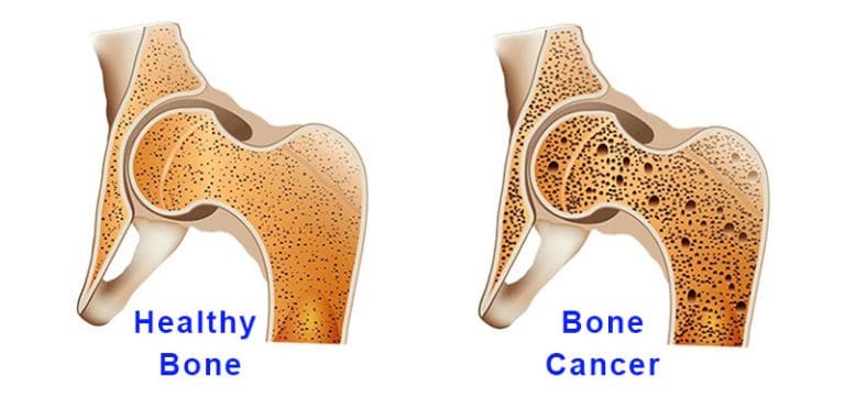 what-causes-bone-cancer-symptoms-stages-and-treatments