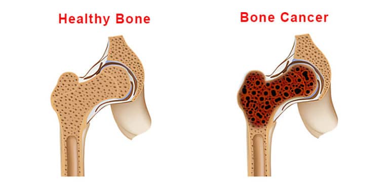 bone-cancer-types-symptoms-causes-and-other-risk-factors