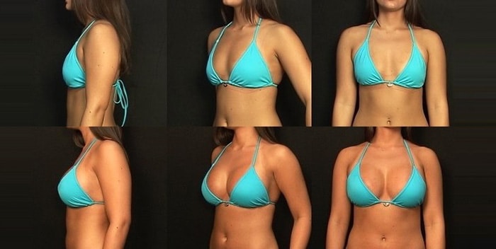 Breast Augmentation Guide Best Methods Surgery Recovery And Cost Daftsex Hd