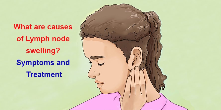 What are causes of Lymph node swelling? Symptoms and Treatment
